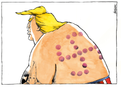 CUPPING MARKS ON TRUMP'S BACK by Michael Kountouris